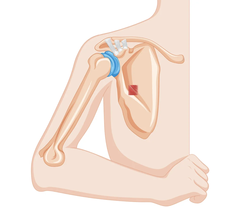 shoulder replacement Dubai